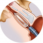 Sonde de dilatation TubaVent® standard – Image 2