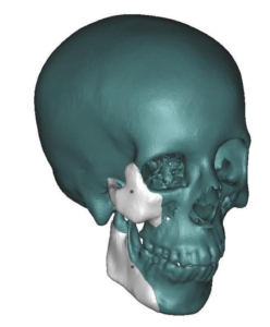 vignette du produit Implants malaires Medpor