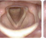 Canule d'injection VoiceInject®-19237