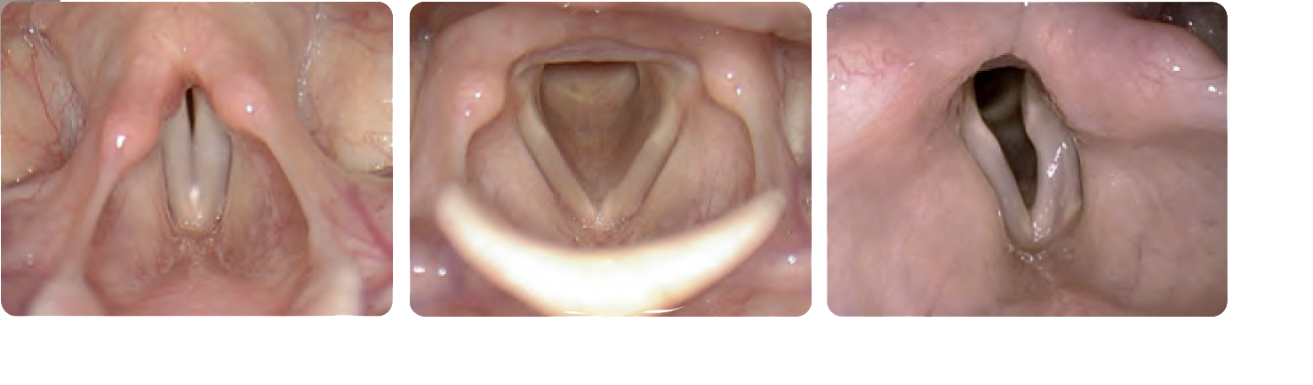 Canule d'injection VoiceInject®-19237