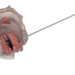 Canule d'injection VoiceInject®-19235