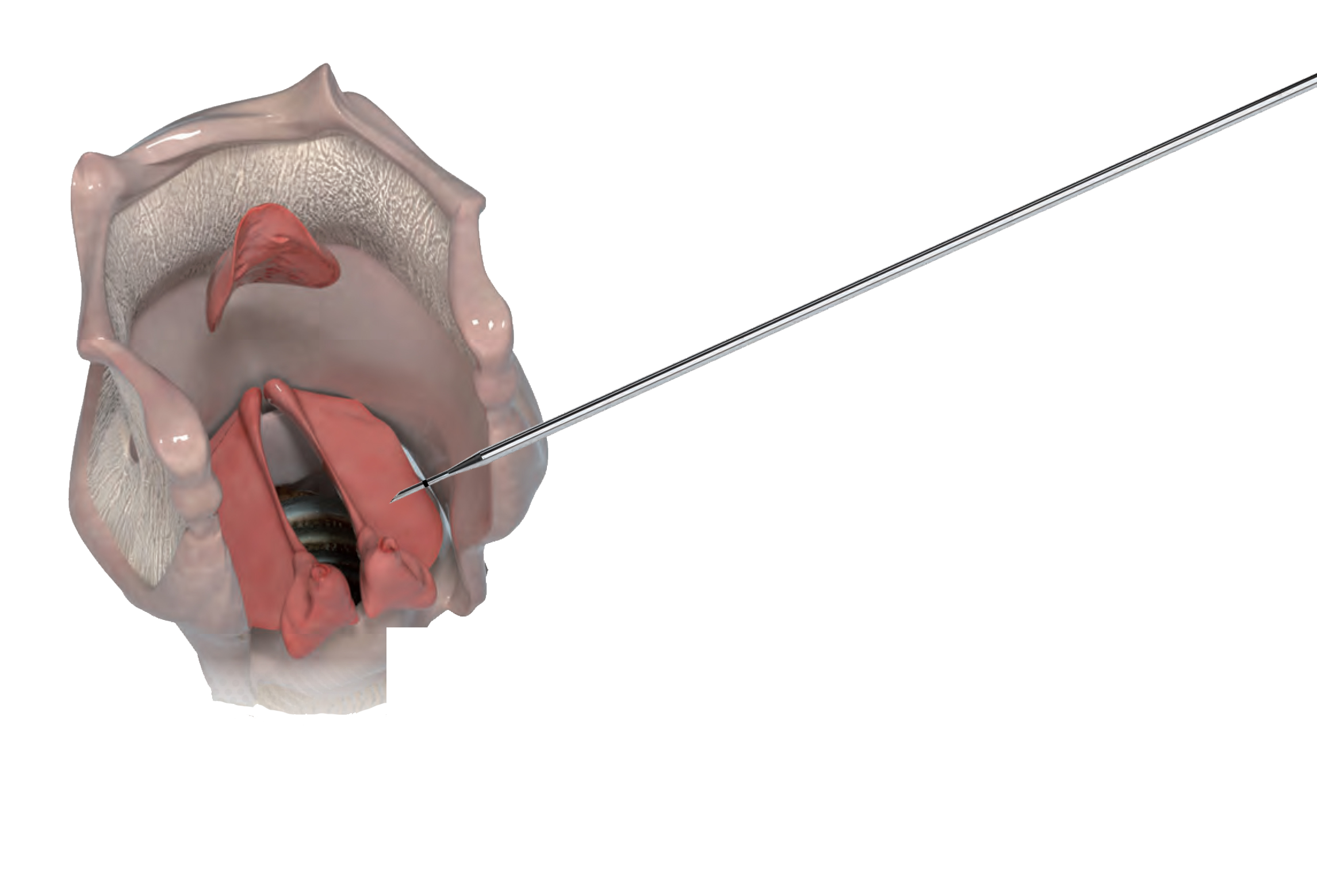 Canule d'injection VoiceInject® Boîte de 5-19242