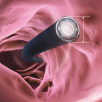 Vidéo rhino-laryngoscope WIFI Mindsion Vision Medical – Image 5
