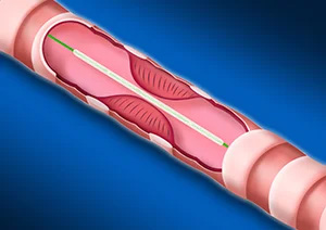 Catheter de dilatation Aeris® – Image 3