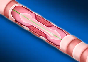 Catheter de dilatation Aeris® – Image 4
