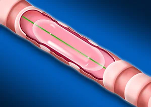 Catheter de dilatation Aeris® – Image 5
